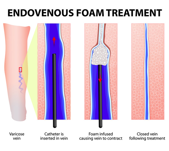 Vein Therapy  Prota Clinic